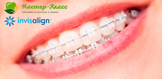 Американские ортодонтические капы Invisalign для исправления прикуса, установка металлических или керамических брекетов в стоматологии «Мастер-класс». **Скидка до 80%**. Москва - kupikupon.ru Американские ортодонтические капы Invisalign для исправления прикуса, установка металлических или керамических брекетов в стоматологии «Мастер-класс». **Скидка до 80%**