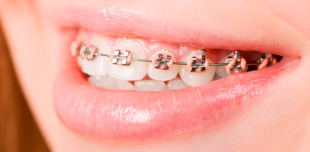 Установка брекетов для взрослых и детей, а также установка детской ортодонтической пластинки в центре «Стоматология для всех». **Скидка до 73%**